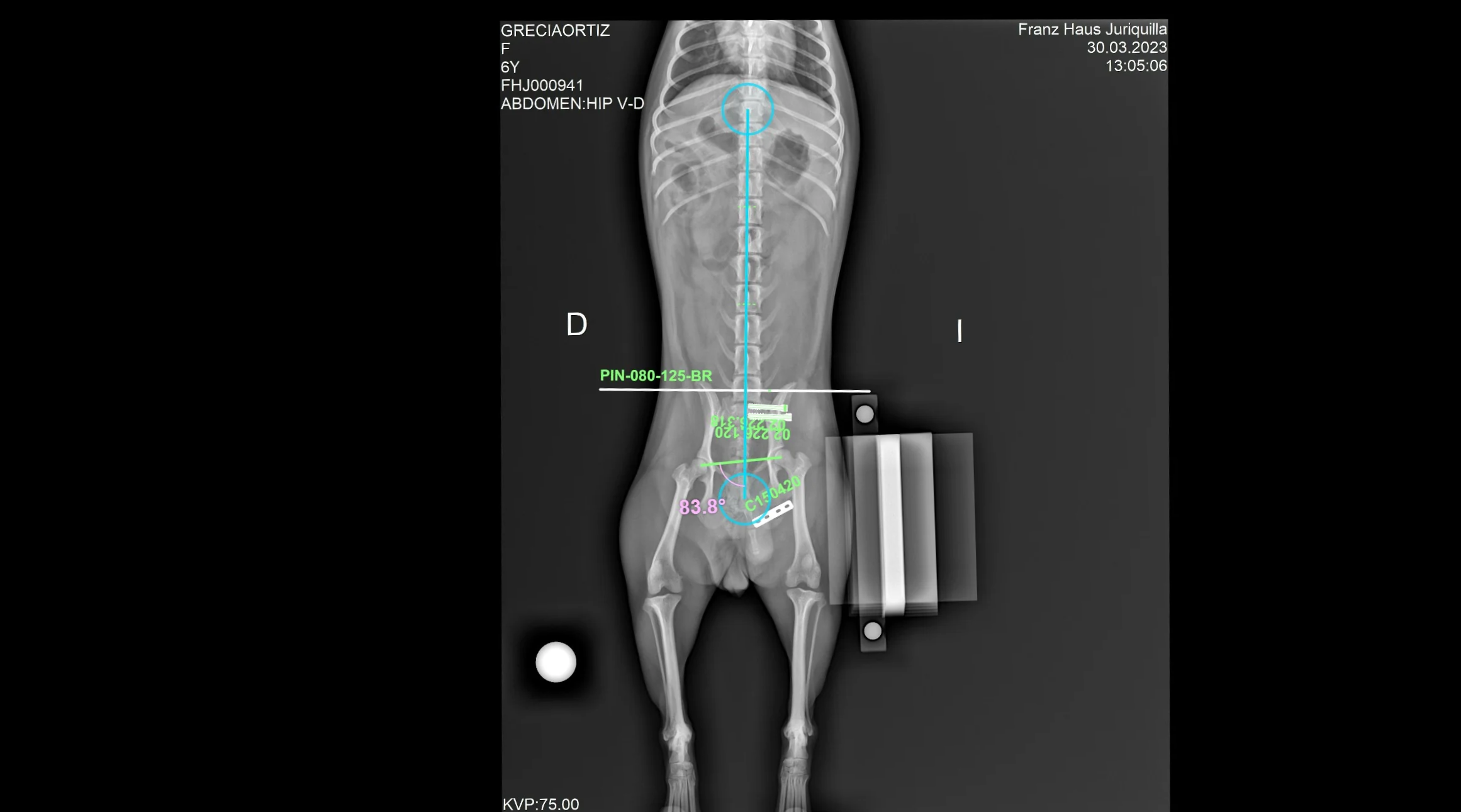 Radiografía de una paciente con fractura compuesta de cadera.